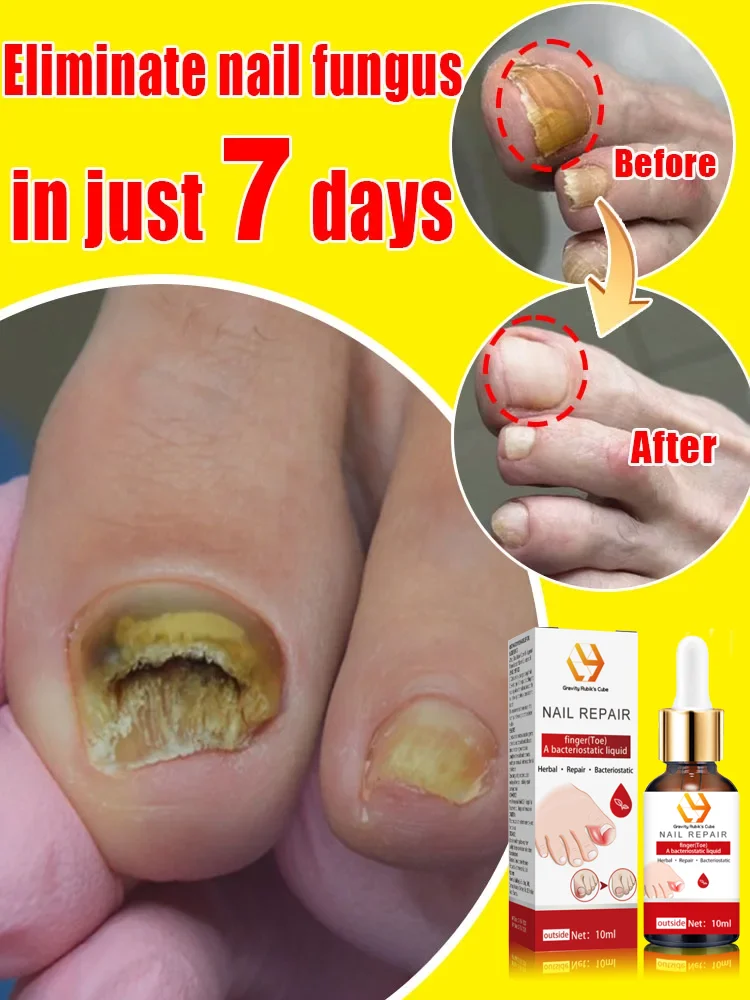 The most powerful black technology in 2024 will completely solve the problem of nail mold!