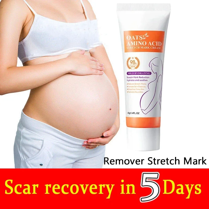 Stretch Marks ครีมกําจัดถาวร กําจัด Body Belly Stretch Marks เครื่องหมายบวม ลบรอยแตกของผิว Repair Firming Care