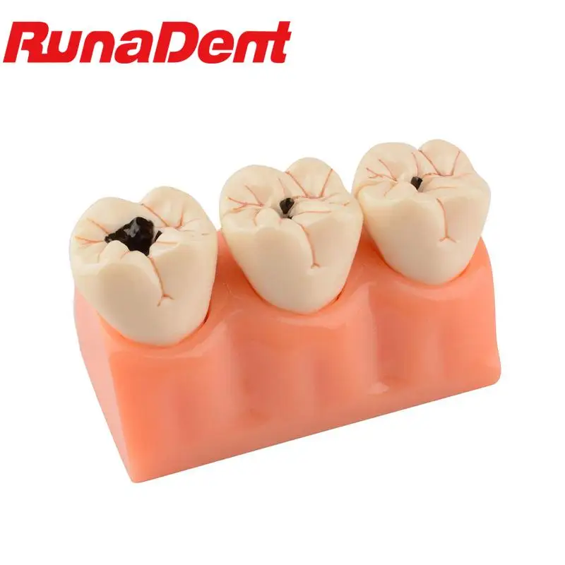 Dentist Teaching Tools Dental Decayed Teeth Model Denture Caries Disease Decomposition Decay Tooth Model