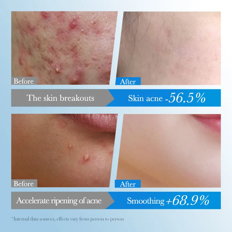 75Patches/Box Star Round Acne Patch Colorful Invisible Acne Removal Skin Care Stickers Concealer Face Spot Beauty Makeup Tools