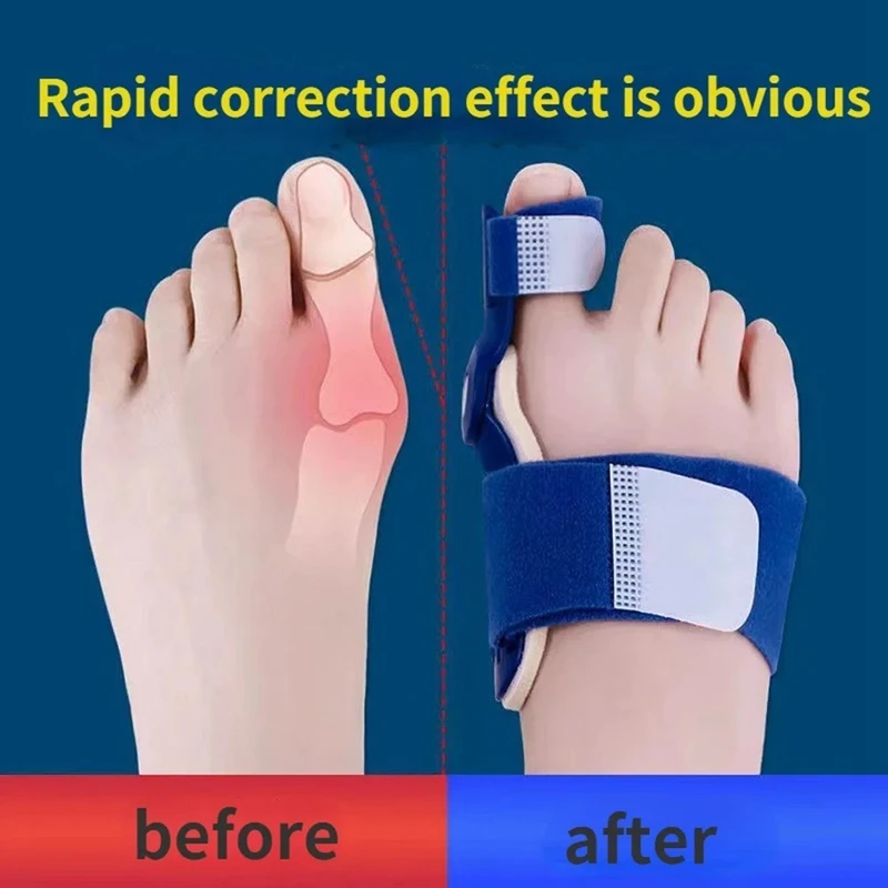 Big Bone Toe Bunion Splint Straightener Corrector Foot Pain Relief Hallux Valgus Feet Care Protector Foot Care Tools