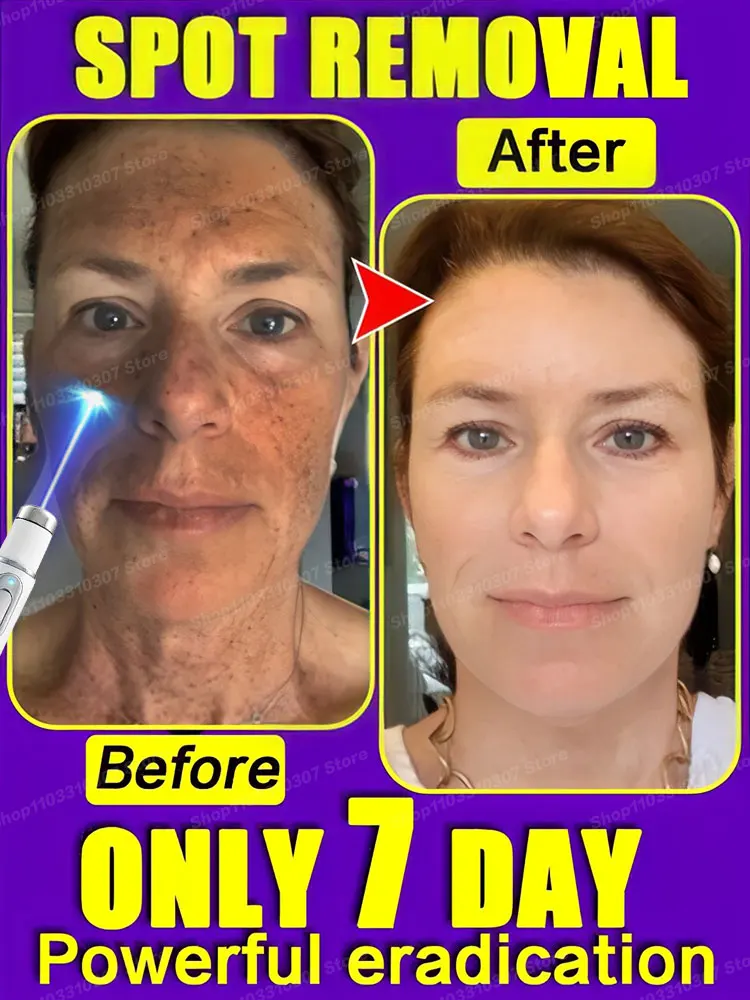 

Laser whitening facial spots