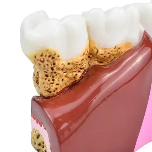 

Dental Caries Anatomy Model Comprehensive Pathology Tooth Nerve Tooth Model for Oral Teaching Teeth Model