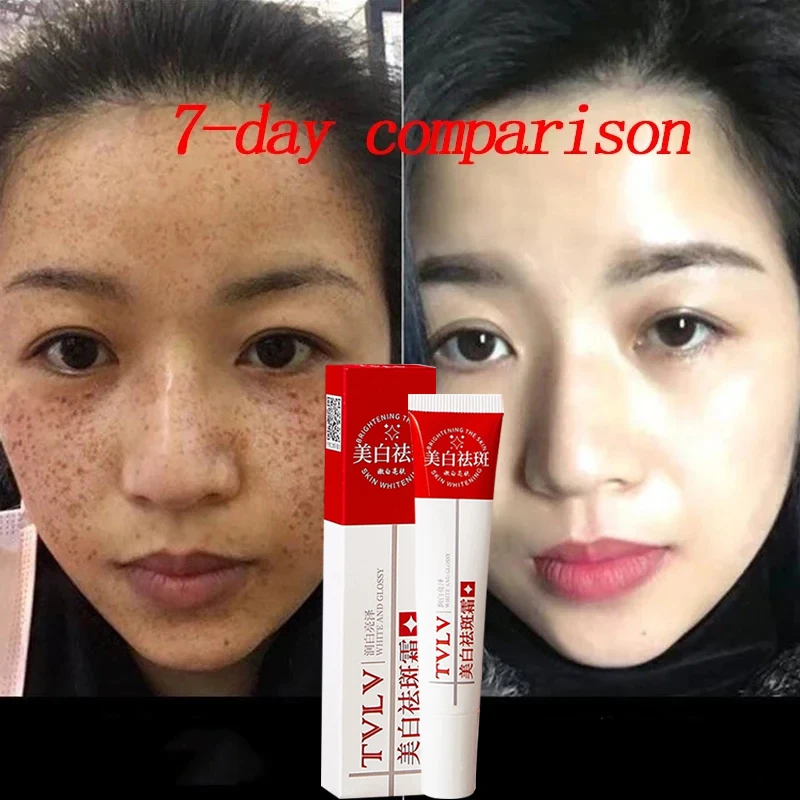 Whitening Freckle Cream Remove Dark Spots Anti Freckle Face Creams Niacinamide Fade Pigmentation Melasma Brighten Skin Care