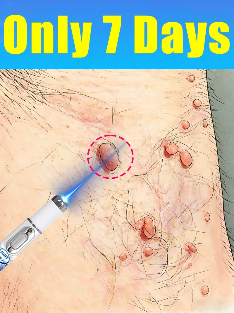 

2026NEW blue light pen to solve neck warts, hot wart care tools