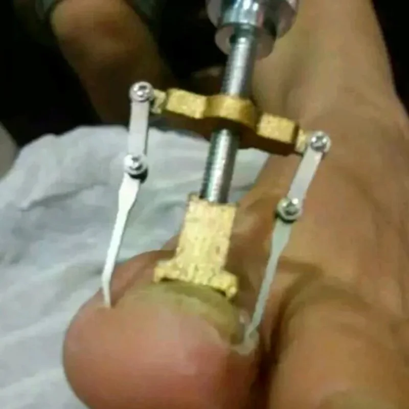 Corrector Profesional para Uña Encarnada