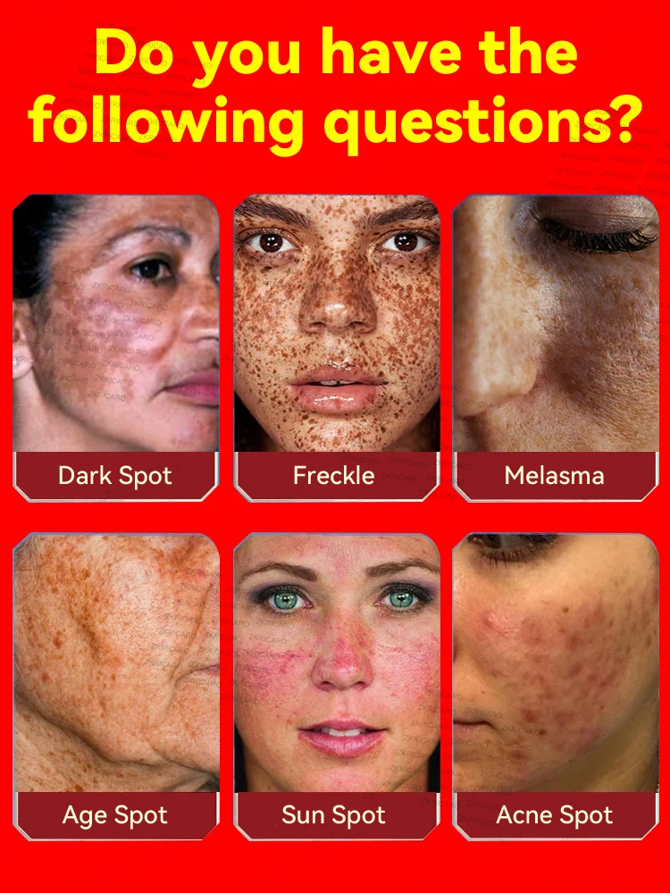 Facial freckles disappear in 7 days