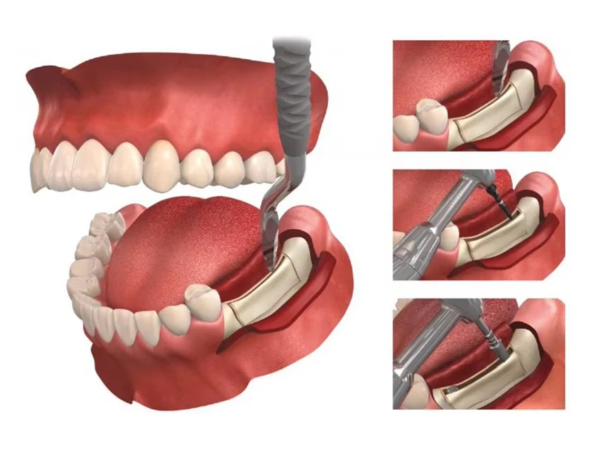 Original Dentium Dental Implant Ridge Spreader RS Drill Instruments Kit dental Implant Titanium dental tools
