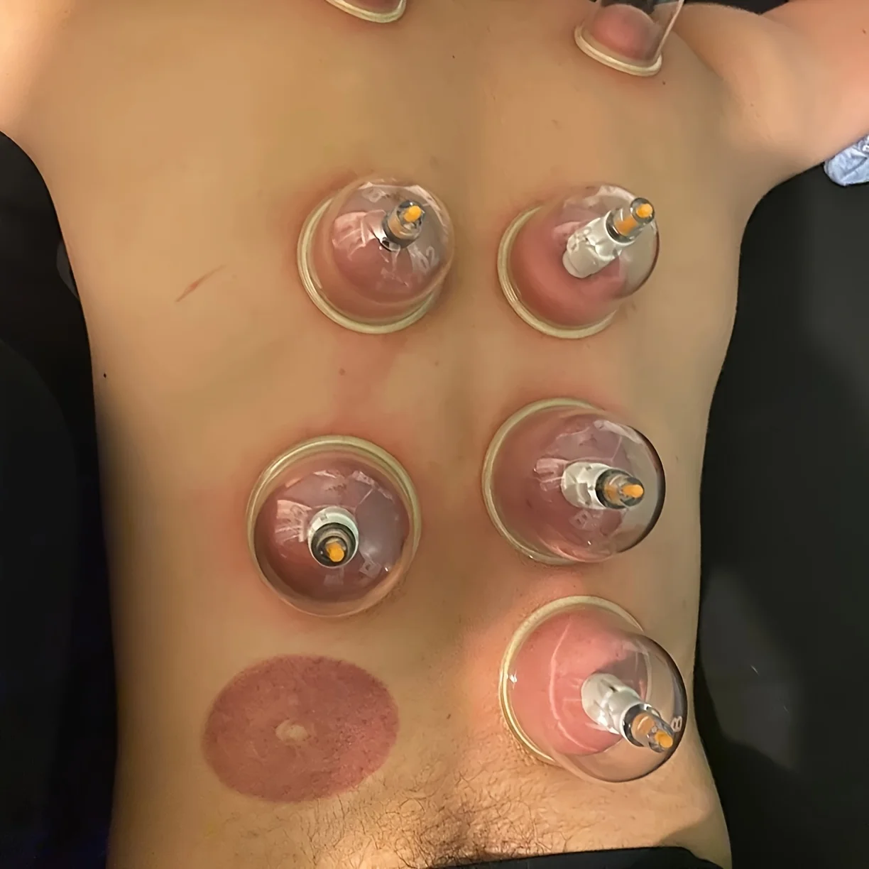 12-teiliges Schröpfset mit Handpumpe und detailliertem Schröpfhandbuch für Verschiedene Größen von Vakuum-Schröpfköpfen - Massage-Schröpfen – Detail 2