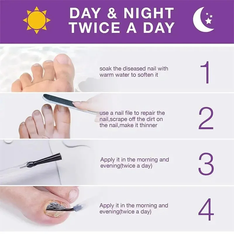 مصل علاج الأظافر الفطرية، علاج إزالة فطريات الأظافر، سائل الداحس، مضاد للأظافر الرمادية، أدوات العناية بإصلاح القدم