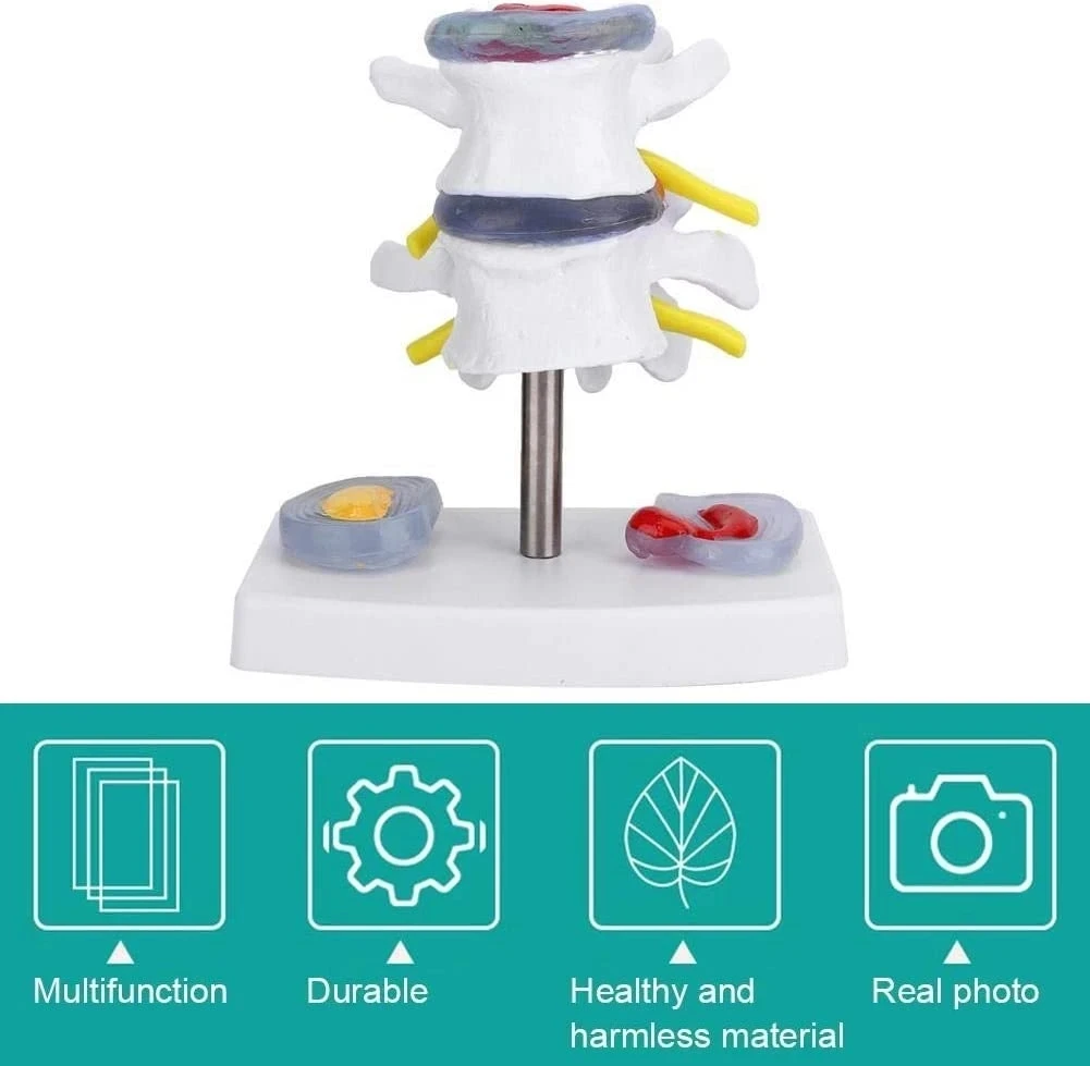 Intervertebral Disc Herniation Bone Pathology Model Lumbar Spine Bone Medicine Teaching Model Medicine Teaching