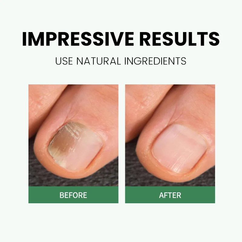 Stylo à bille pour cuticules à ongles – Huile nourrissante pour cuticules sèches, empêche les ongles et les fissures, Application facile