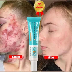 Creme para Remoção de Acne, Cravos Tratamento Ácido Salicílico, Controle de Óleo, Poros, Encolhimento, Hidratação, Clareamento, 7 Dias