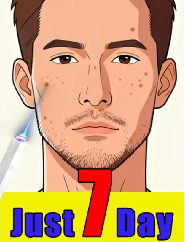 عرض ساخن لعام 2025، قلم الضوء الأزرق يحل الثآليل، أدوات العناية بالثآليل، للجنسين #1