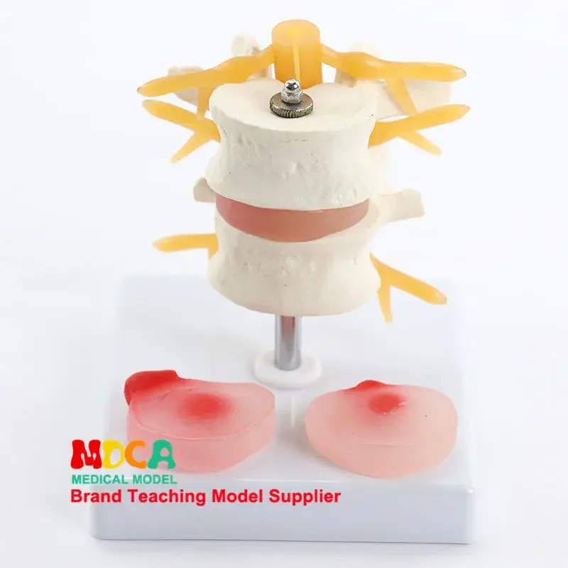 Medical Teaching Of Human Skeletal Spinal Model With Two Lumbar Vertebral Lesions And Intervertebral Discs MYZ001