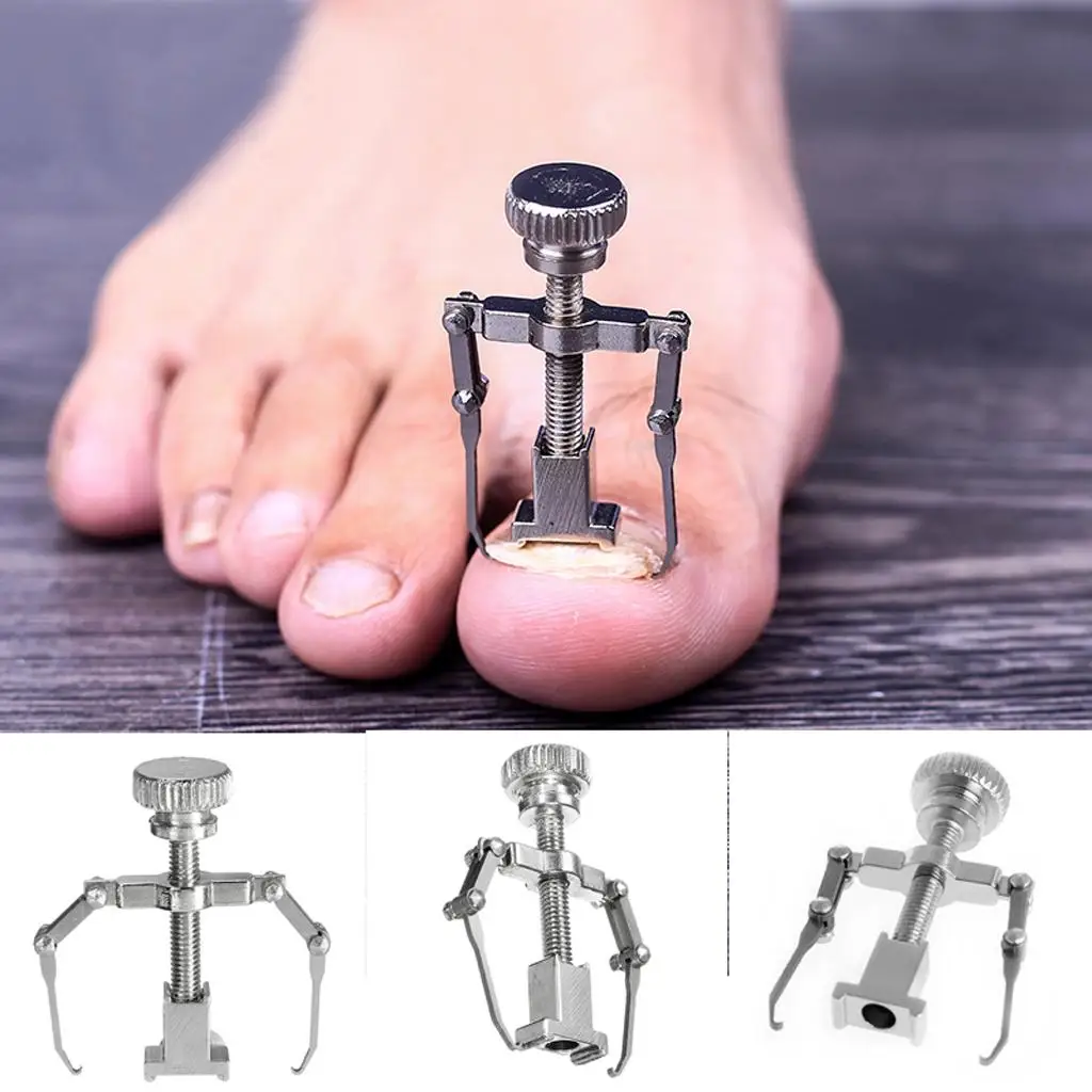 Ingrown Toe Nail Fixer Pedicure Toenail Orthotic Bunion Treatment