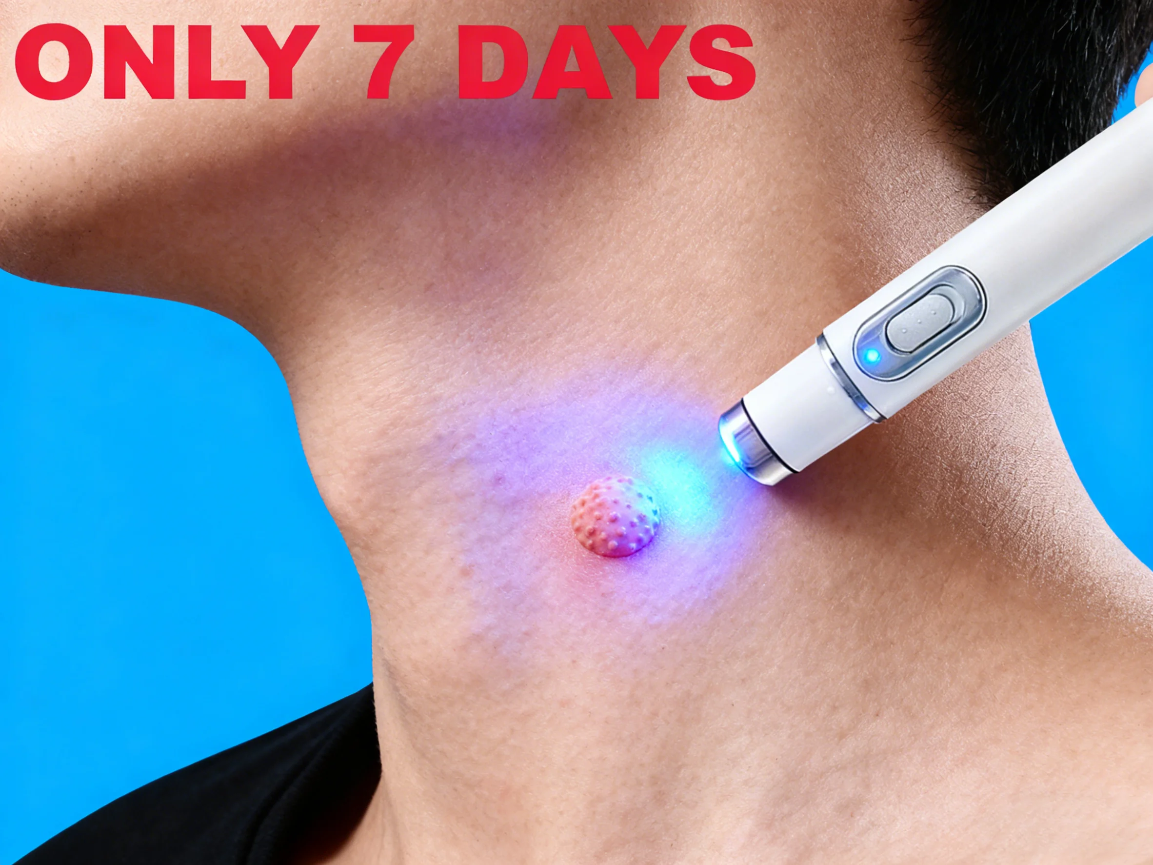 ᵂᵃʳᵗ ʳᵉᵐᵒᵛᵃˡ ᵃᵗ ʰᵒᵐᵉ ⁱˢ ˢᵘᵖᵉʳ ᶜᵒⁿᵛᵉⁿⁱᵉⁿᵗ! Warts will gradually fall off