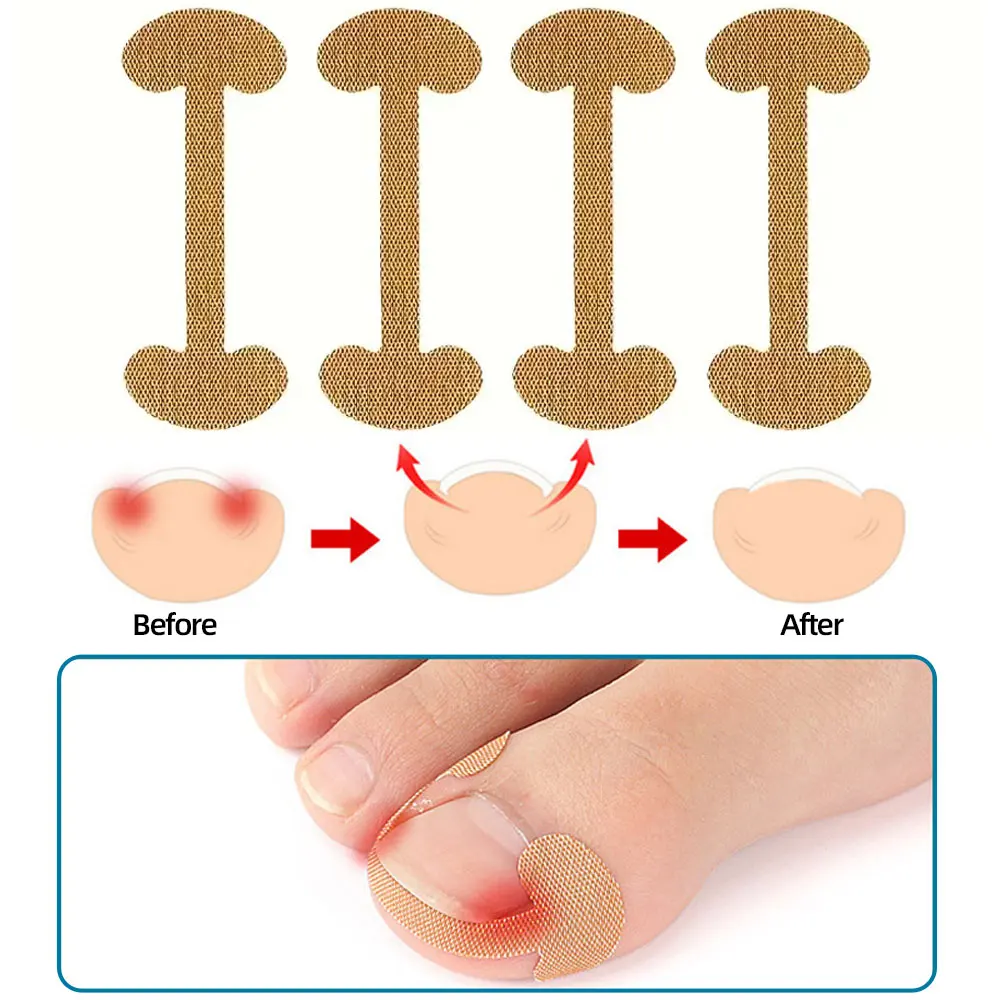 40/60/80 Uds almohadillas correctoras de uñas en línea, parches para uñas de los pies, pegatinas para uñas sin pegamento, Kit de herramientas de pedicura profesional