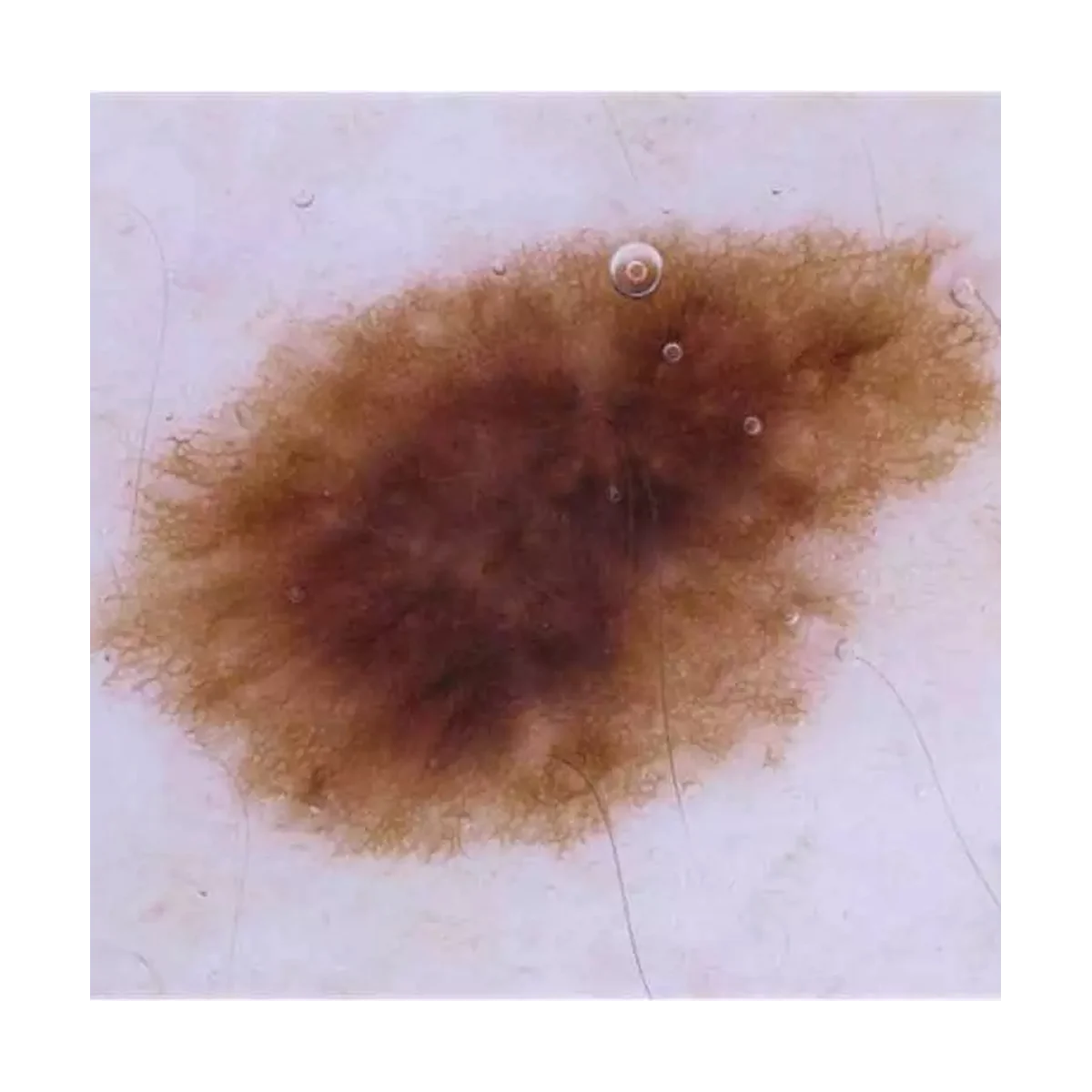 Imagem -04 - Dermatoscópio Portátil Microscópio para Dermatologista Equipamento Médico Full Frame 10x