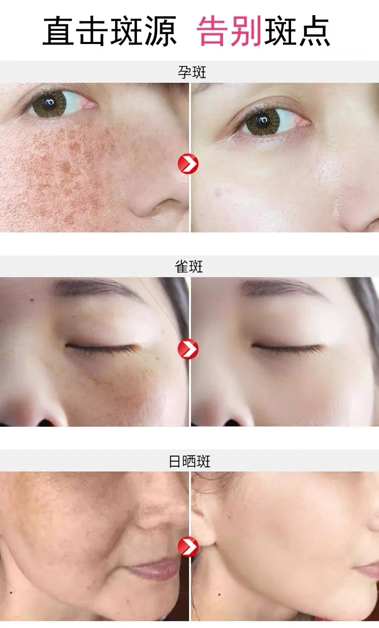 20g+20g Original Danxuenilan Brightening Moisturizing Whitening Freckles Women Beauty Facial Care Cosmetics 2 in 1