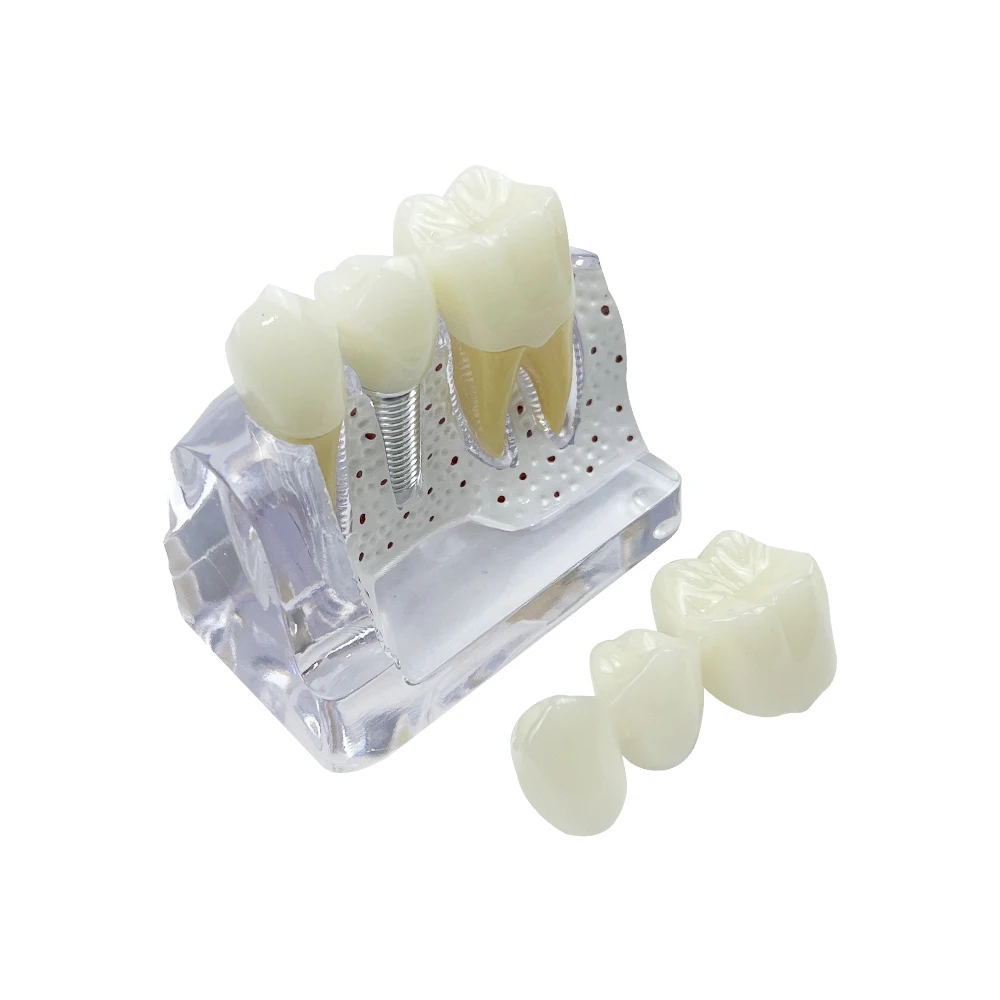 Dental 4 Times Implant Teeth Teaching Model for Dentist Student Practice Studying Training Doctor-patient Communication Tools