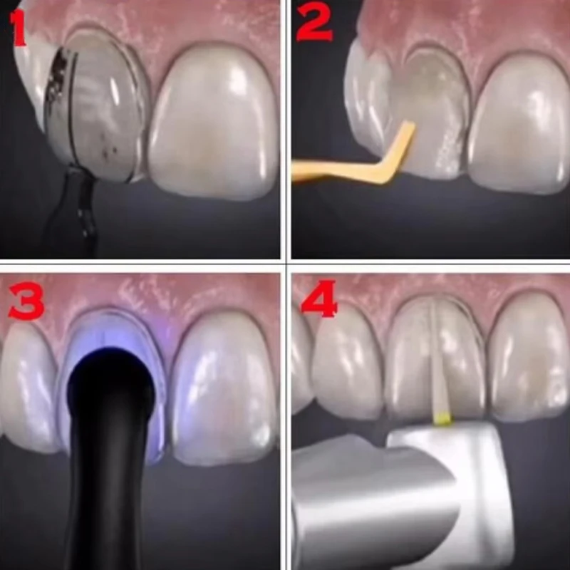 30 stks/set Doos Tandheelkundige Fineer Schimmel Hars Composiet Licht Uitgeharde Tanden Bovenste En Onderste Tanden Whitening Tandheelkundige Tool Materiaal