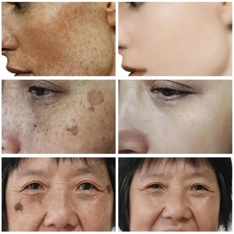 New Removal Melasma Freckle Face Cream Dark Spot Remove Whitening Fade Pigmentation  Improve Dullness Moisturize Beauty-health