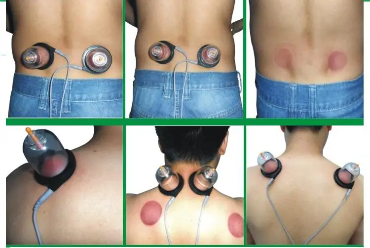 Elektronische Puls Cupping Massage Apparaat Terug Lumbale Hele Lichaam Elektrische Therapie Cupping Apparaat Acupunctuur