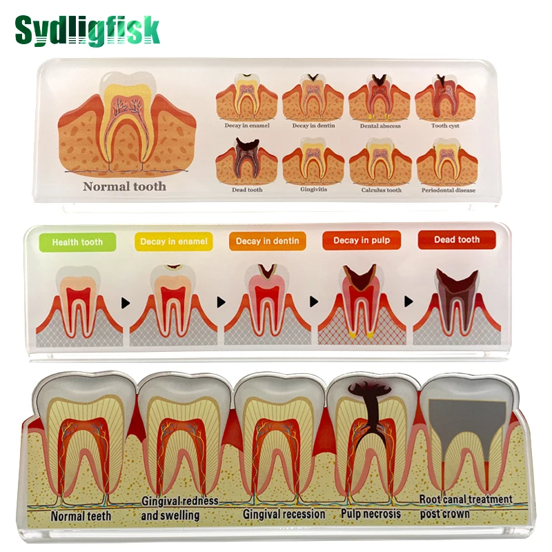 1Pcs Dental Disease Tooth Model Teaching Model Pathology Demonstration Model Doctor-Patient Communication Model Dentist Gift