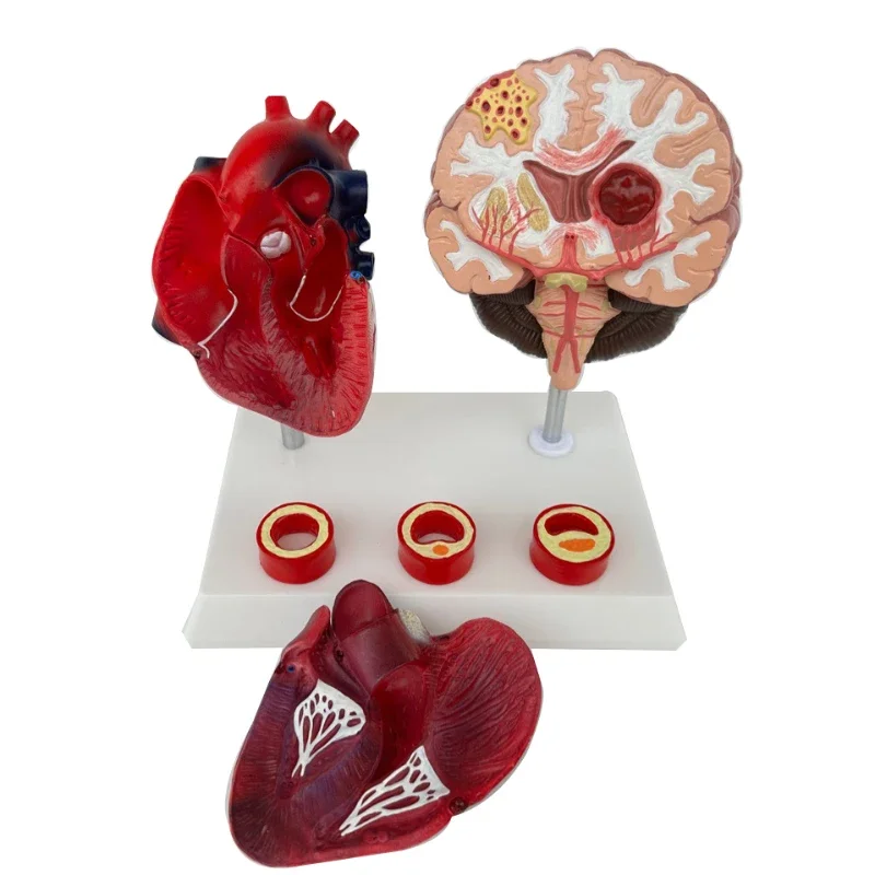 Human cardiovascular and cerebrovascular blockage pathological cerebral blood cardiovascular lesion demonstration teaching mold