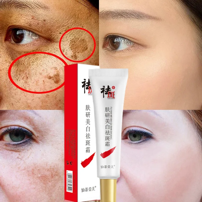 

Effective Whitening Freckle Cream Remove Dark Spots Anti Freckle Cream Fade Pigmentation Melasma Brighten Creams Skin Care 20G