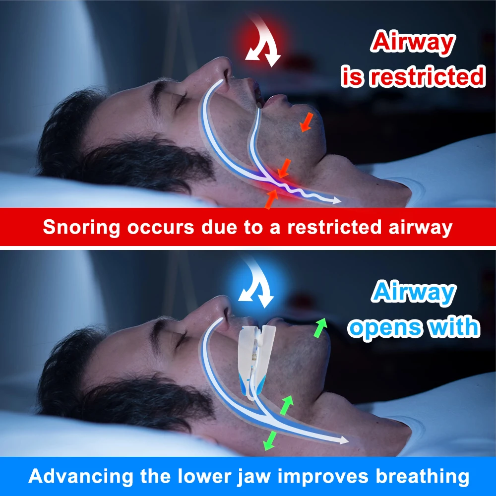 Adjustable Anti-Snoring Mouthpiece Anti Snoring Mouth Guard Sleeping Devices Bruxism Snoring Stopper Improve Sleep Mouthpiece