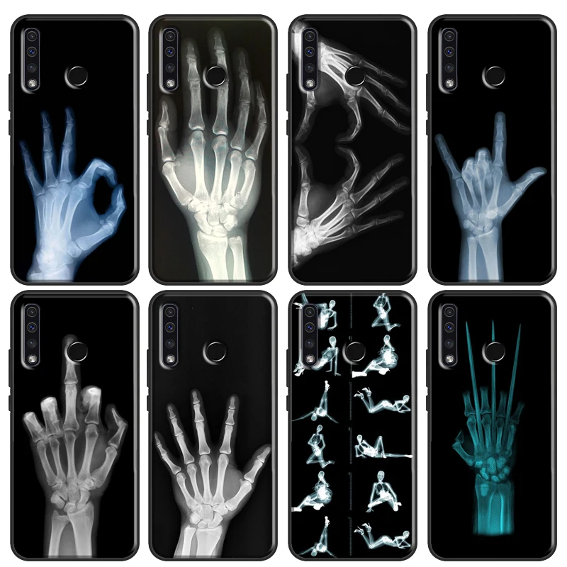 X-ray Hand Bones Case For Huawei P30 P20 P40 P60 Pro Nova 9 5T P Smart Honor Magic 5 Lite X8 X9a 50 70 Cover