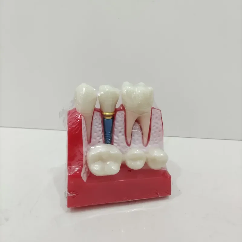 Custom Medical Oral Teaching Training Demonstration Standard Teeth Implanting Model for Dentist Student Studying