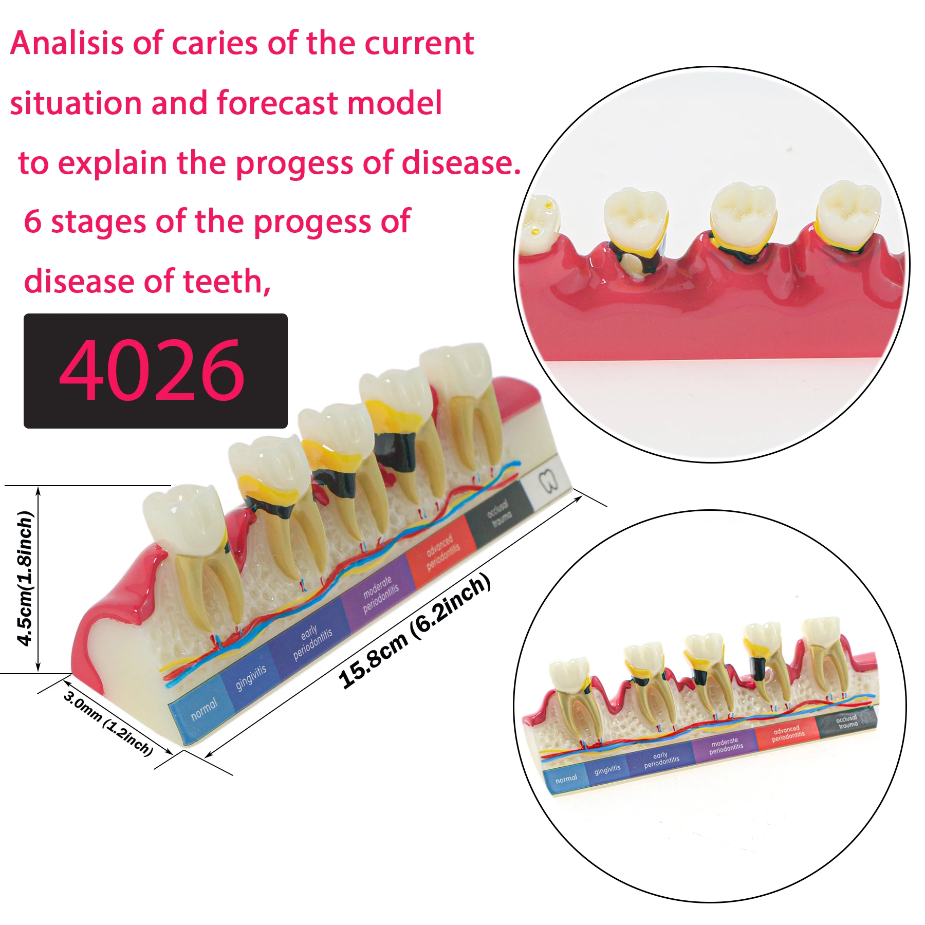 

Dental Model Disease Tooth Model Tooth Dental Teaching Model for Dentist Teaching Training Doctor-patient Communication M4026