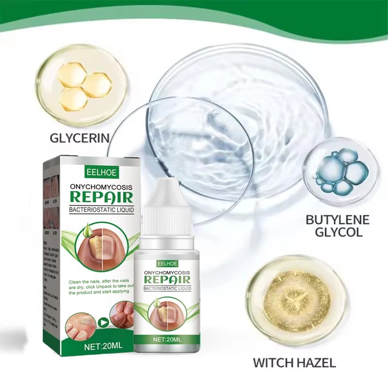 زيت علاج الأظافر الفطرية، إصلاح القدم، جوهر إزالة فطريات الأظافر، كريم مضاد للعدوى، إزالة الأظافر الفطرية