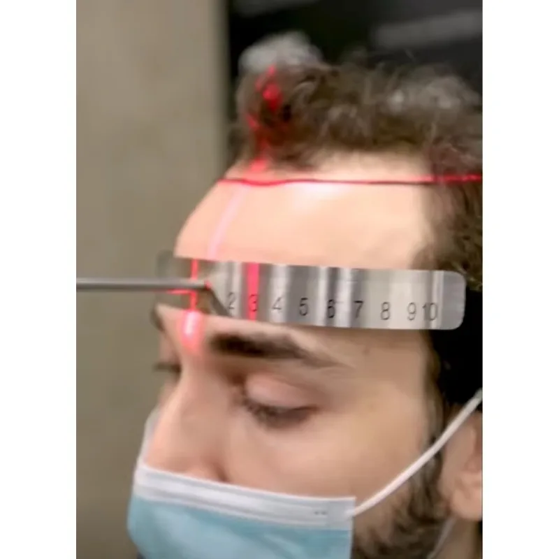 أداة قياس فروة الرأس الرقمية المعتمدة من CE للشحن السريع، مسطرة خط الشعر اليدوية لجراحة FUE، تصميم زراعة الشعر #6