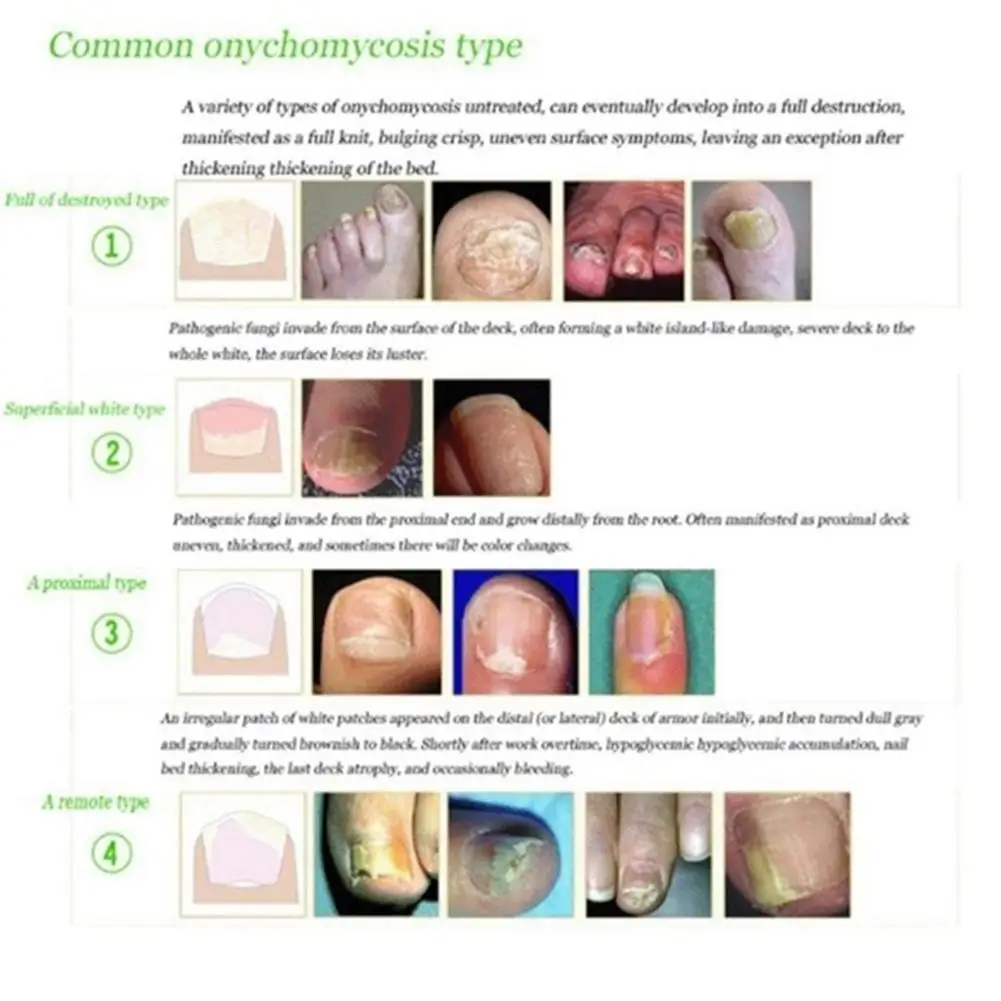 Fungus Removal Liquid Fungal Nail Treatment Foot Care Toe Nails Repair Care Essence Natural Plant Foot Nail Anti Infection Oil