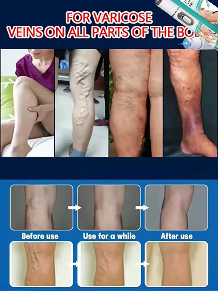Effective treatment for varicose veins, relieves dilated vasculitis of leg phlebitis, avoids surgical pain