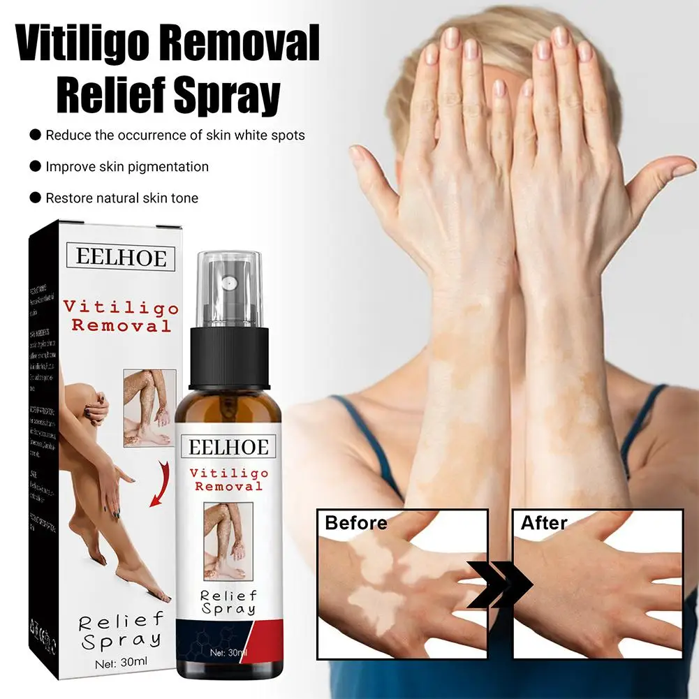 30ml Relief Spray Skin Moisturizing Vitiligo Net Spray Skin Repair Body Face Fades Vitiligo Spot White Spots Repair