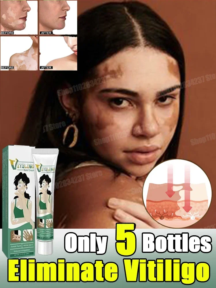 

Vitiligo care cream suitable for skin vitiligo white spots reduce spots