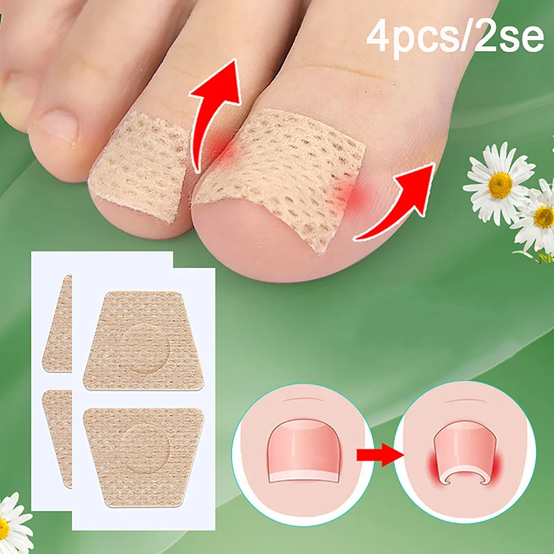 Ingrown Toenail Correction Anti Paronychia Treatment Toe Nail Sticker Foot Care Pedicure Foot Orthodontic Toe Thumb Nail Patches