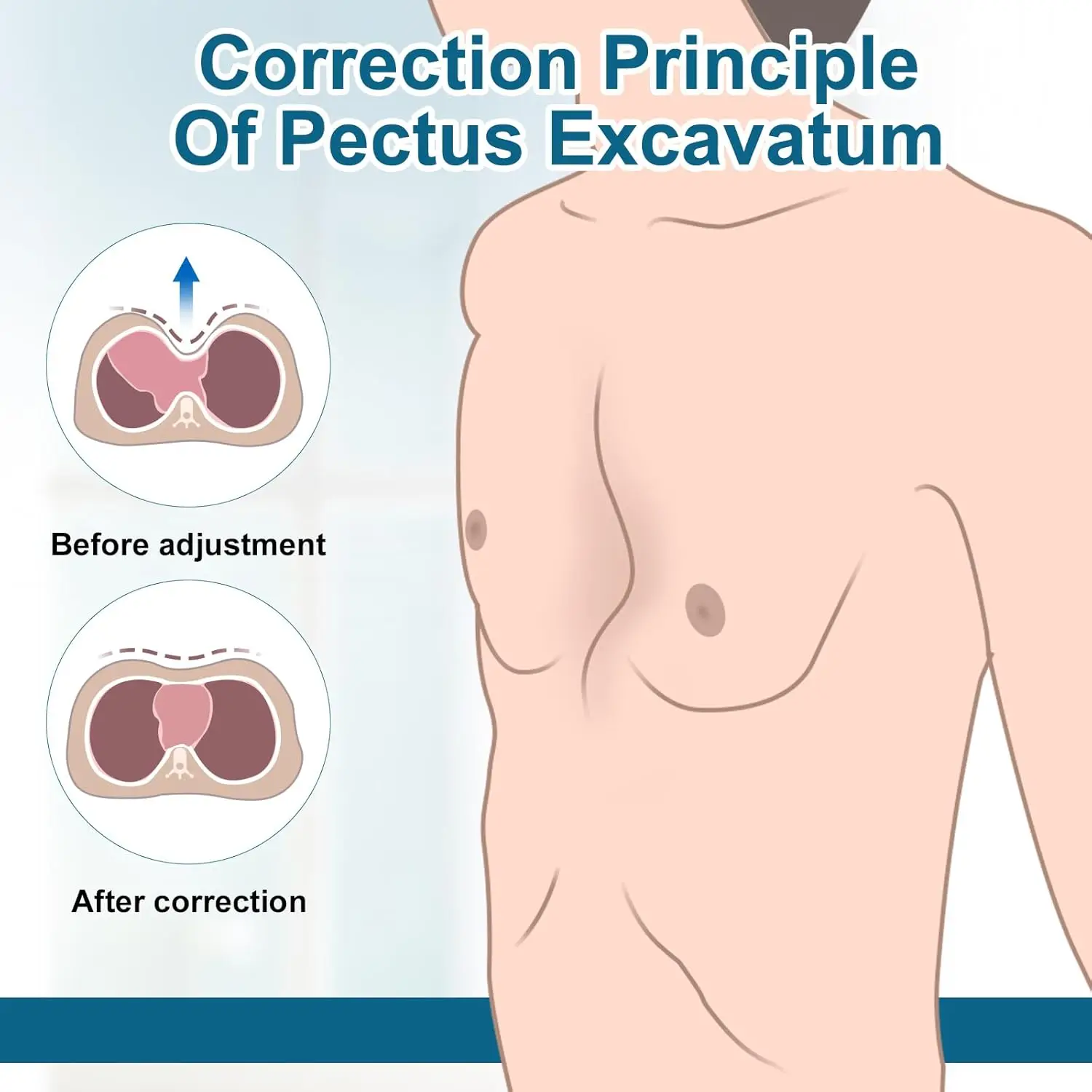جرس فراغ حفارة Pectus - دعامة جبيرة حفارة Pectus، تصحيح جسدي، قابل للغسل، مع مقياس الضغط