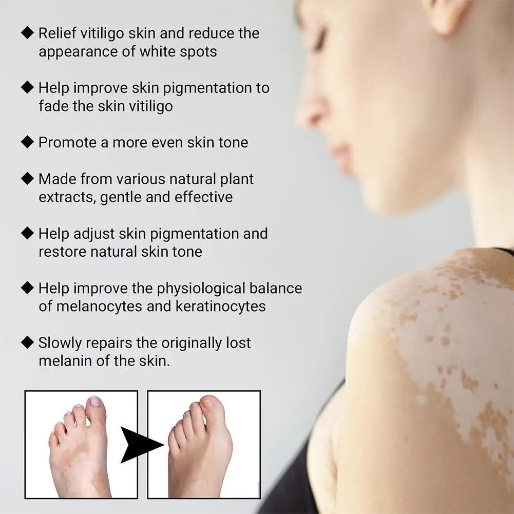 30ml Relief Spray Skin Moisturizing Vitiligo Net Spray Skin Repair Body Face Fades Vitiligo Spot White Spots Repair