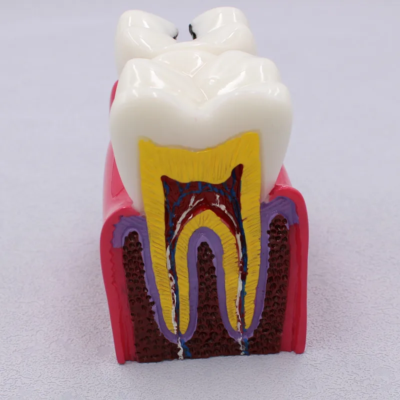 1 Pc Dental material laboratory dental model with 6 caries comparisons: a model for doctor-patient communication