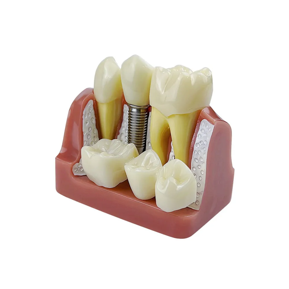 Dental Teeth Model 4 Times Implant Analysis Crown Bridge Removable Model Dentist Student Teaching Training Demonstration Tools