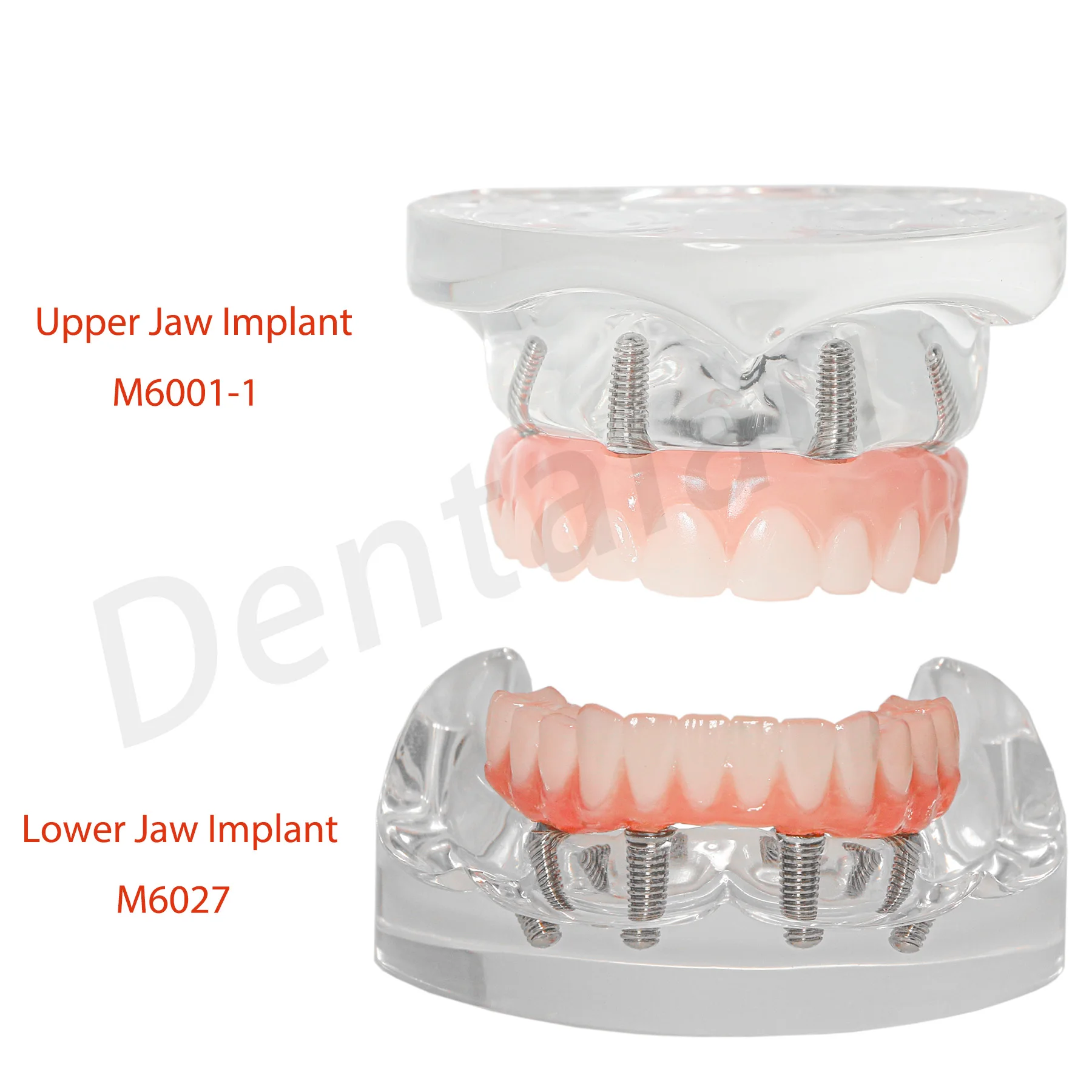 Dental Upper/Lower Jaw Type All on 4 Overdenture Modle With 4 Screws Restoration