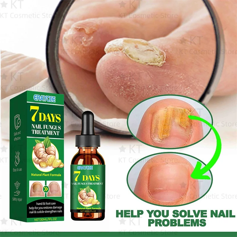 7 日間真菌爪治療血清足の爪真菌除去修復ジェル抗感染爪周囲炎爪真菌症足の爪ケア