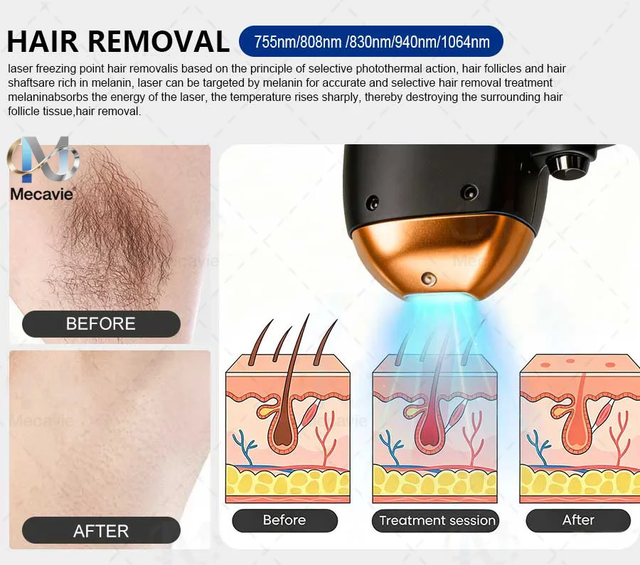 4 In 1 Soprano Titanium Ice Laser Hair Removal Device Alexandrite 808nm Diode Laser System Painless Permanent Body Hair Removal