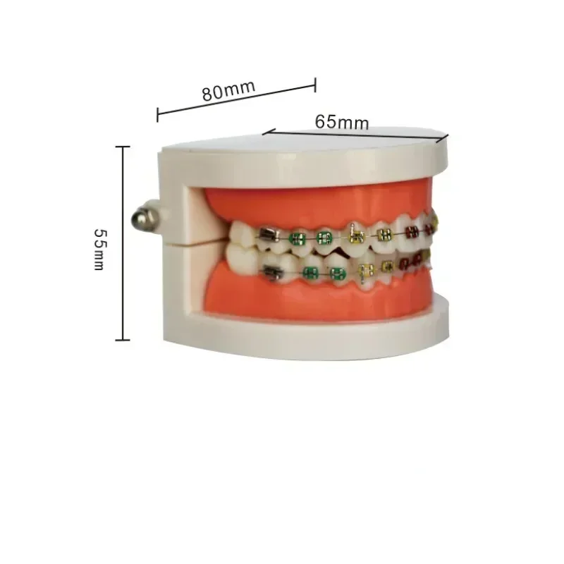 치과 교정 치아 모델 복원 가능 모델, 환자 통신 치과 의사 데모 연구 크라운 서멧 대조 브래킷